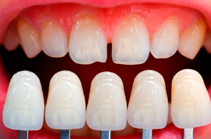 Carillas Dentales